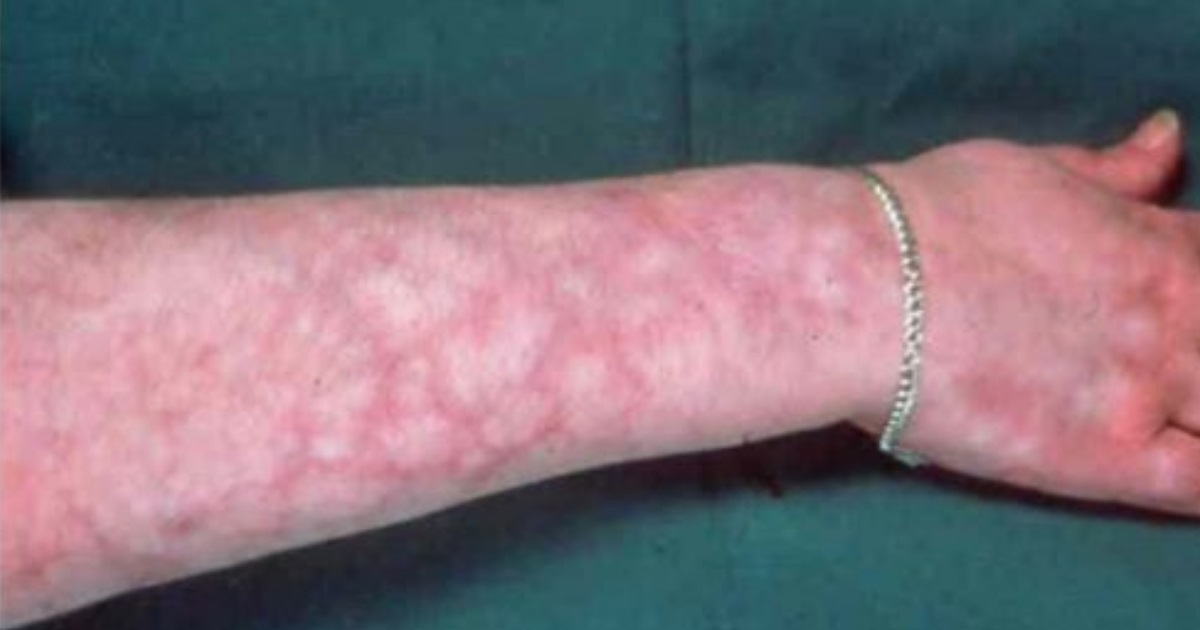 Mottling Of Skin Images Mottling Of Skin Images
