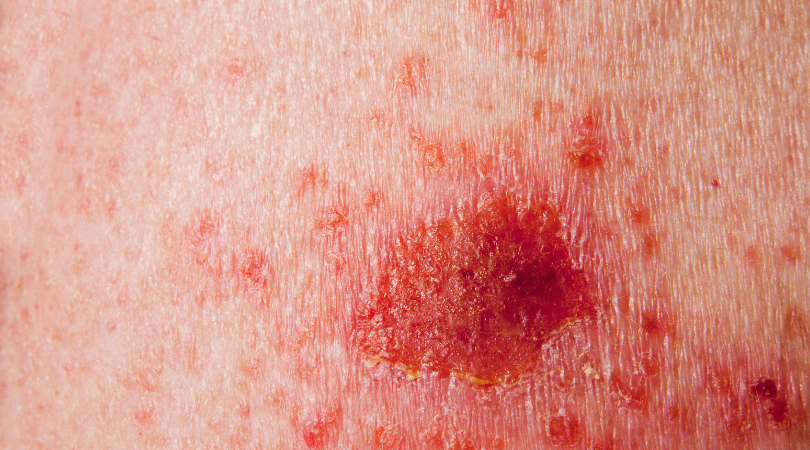 how is skin cancer diagnosed